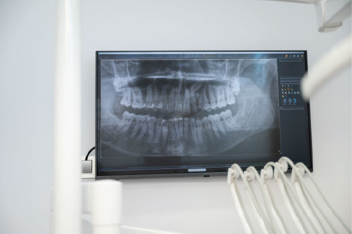 Dental panoramic X-ray displayed on a clinic monitor