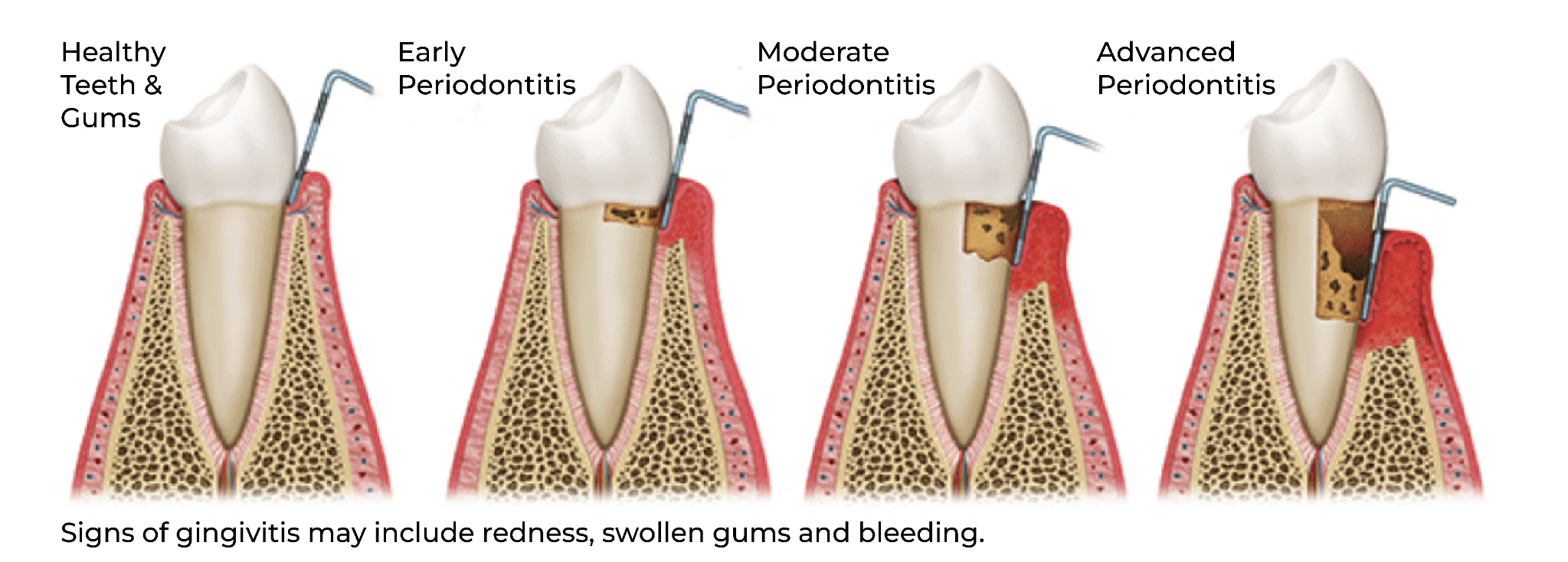 Illustration showing healthy gums and stages of periodontitis from early to advanced