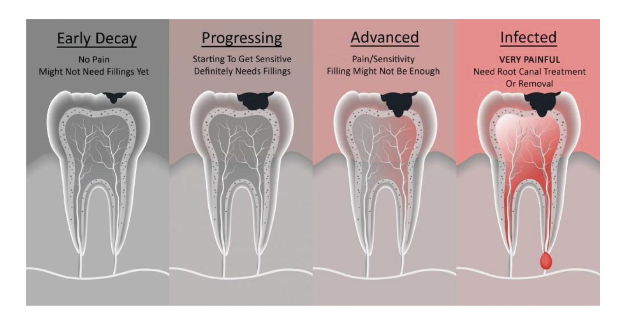 Illustration showing stages of tooth decay